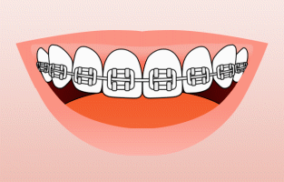 Types of Braces - Whistler Orthodontic Center