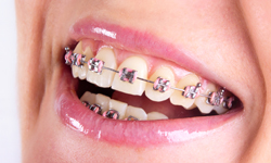 https://www.whistlerorthodonticcentre.com/sesame_media/images/types-of-braces/traditional-metal.jpg